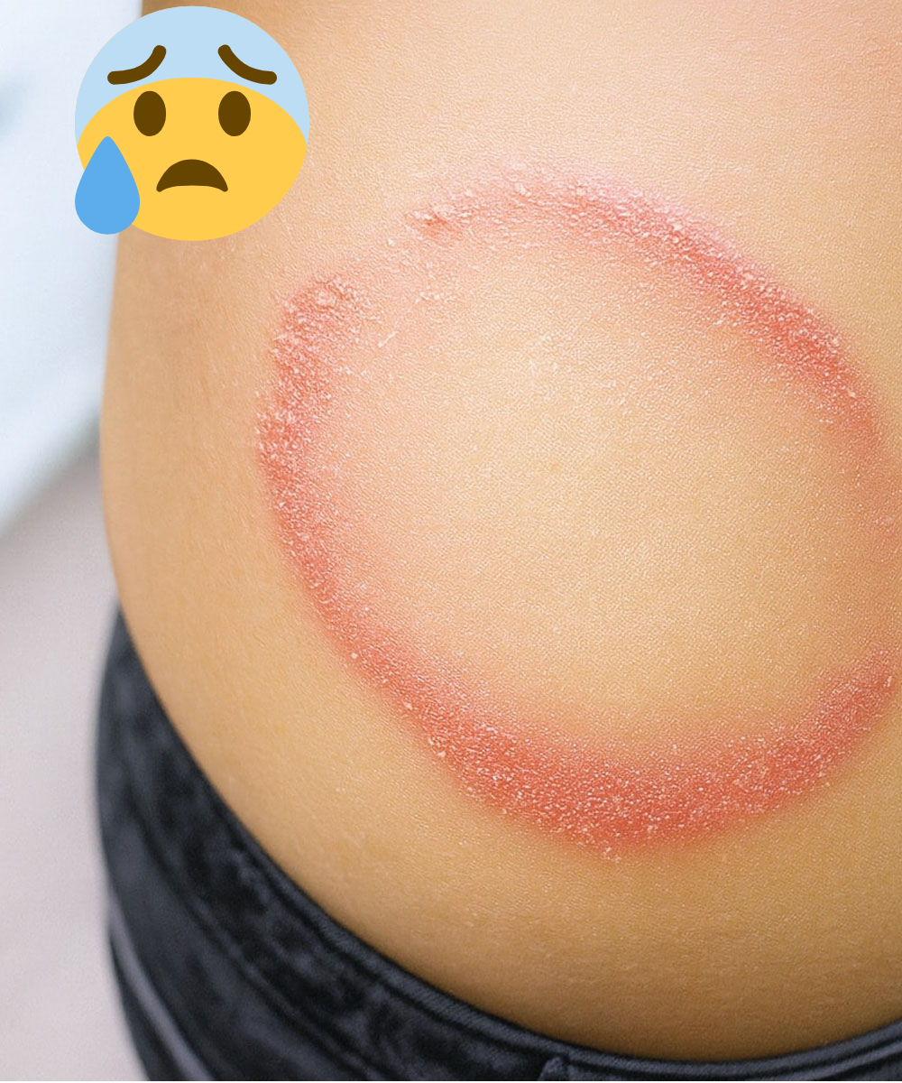 Buni Image How to identify and cure skin fungus or ringworm. – USA